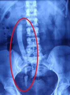 World's Longest Ureteric Stone