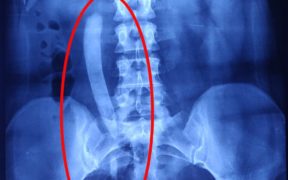 World's Longest Ureteric Stone