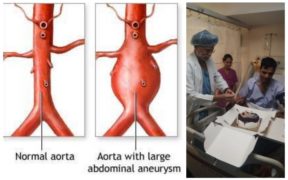 aorta artery